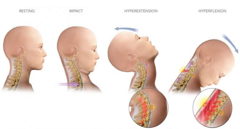 american-chiropractic-whiplash-treatment