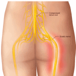 lower back sciatica nerve pain